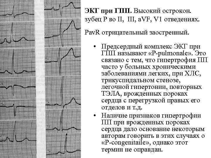 ЭКГ при ГПП. Высокий острокон. зубец Р во II, III, a. VF, V 1