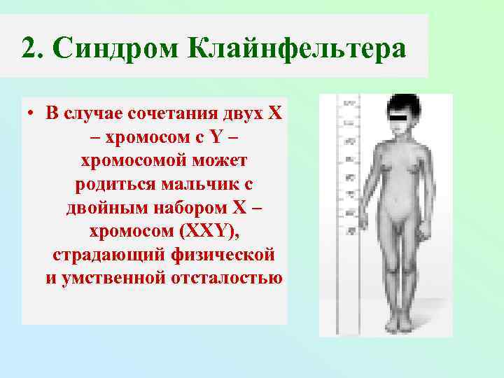 2. Синдром Клайнфельтера • В случае сочетания двух Х – хромосом с Y –