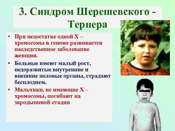 3. Синдром Шерешевского Тернера • При недостатке одной Х – хромосомы в геноме развивается