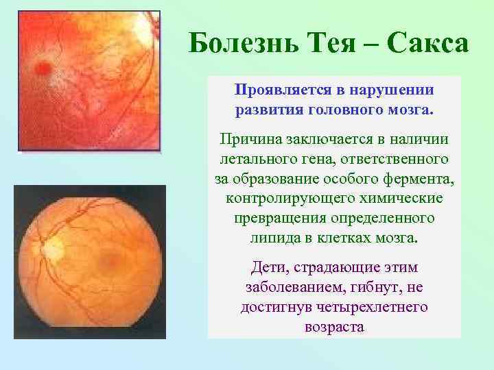 Болезнь Тея – Сакса Проявляется в нарушении развития головного мозга. Причина заключается в наличии