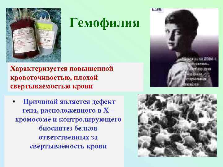 Гемофилия Характеризуется повышенной кровоточивостью, плохой свертываемостью крови • Причиной является дефект гена, расположенного в