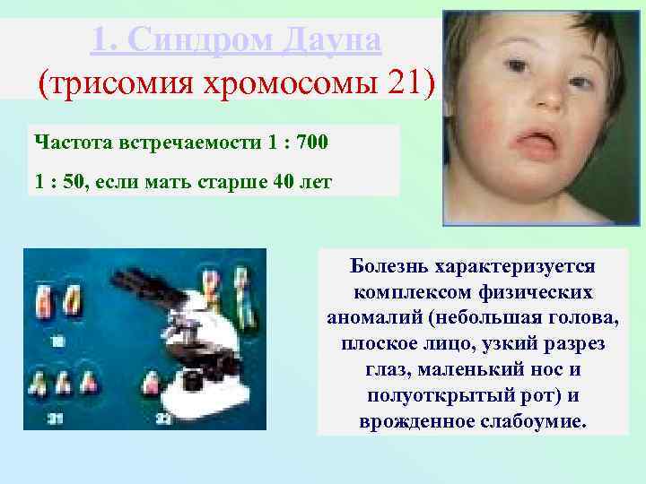 1. Синдром Дауна (трисомия хромосомы 21) Частота встречаемости 1 : 700 1 : 50,