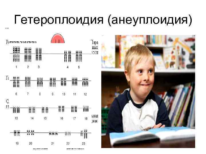 Гетероплоидия (анеуплоидия) Кариотип мужчины, страдающего синдромом Дауна. 