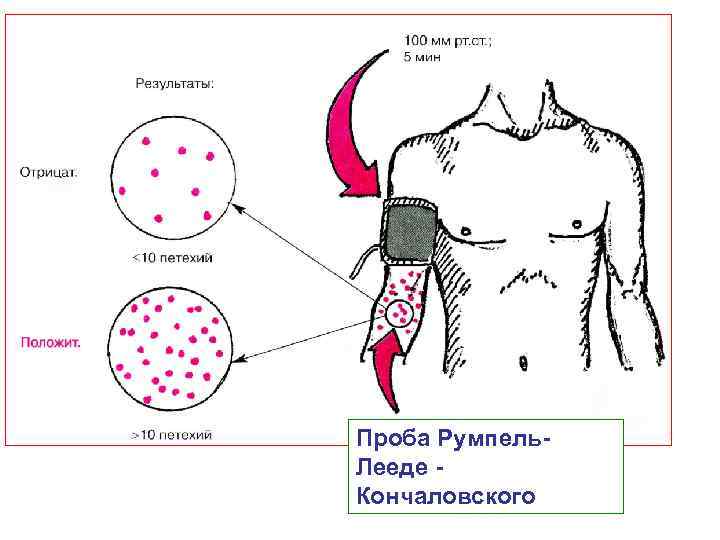 Проба Румпель Лееде Кончаловского 