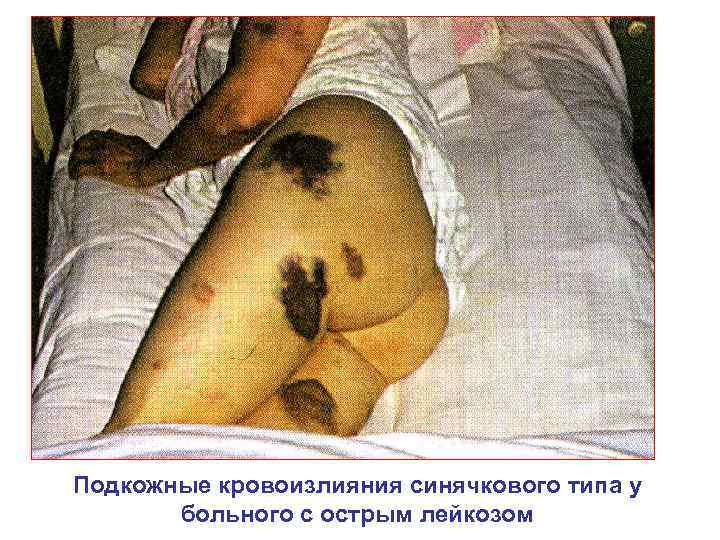 Подкожные кровоизлияния синячкового типа у больного с острым лейкозом 