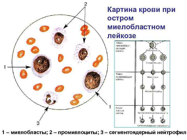 Картина крови при миелобластном лейкозе остром