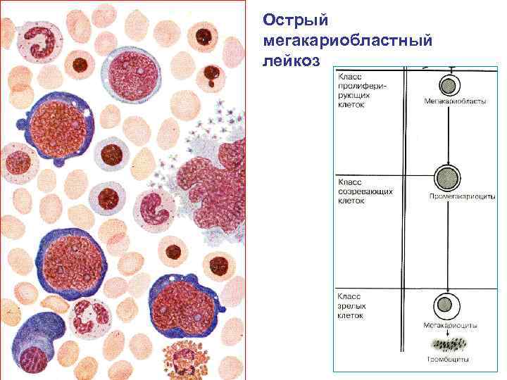 Острый мегакариобластный лейкоз 