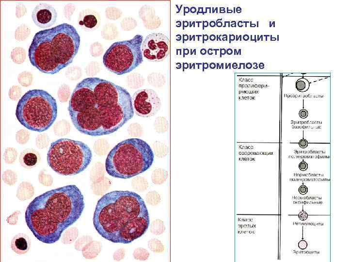 Эритромиелоз картина крови