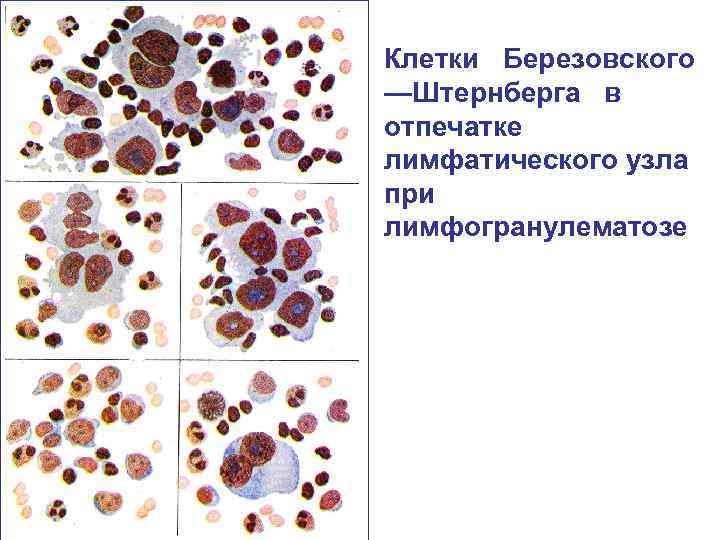Клетки Березовского —Штернберга в отпечатке лимфатического узла при лимфогранулематозе 