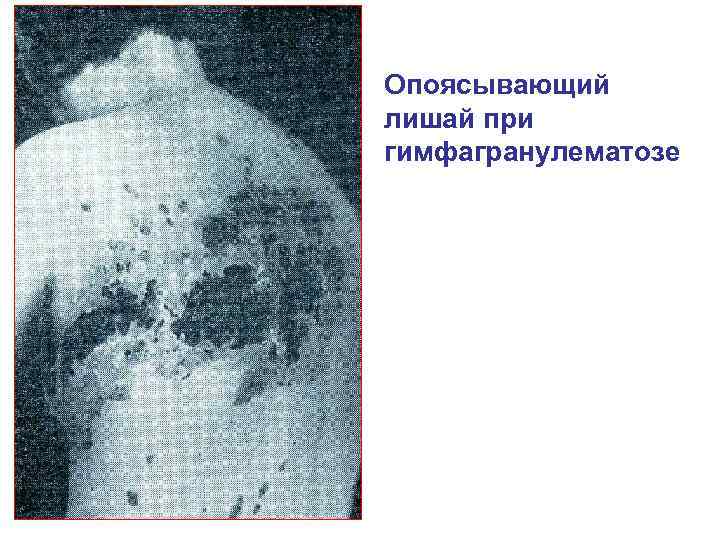 Опоясывающий лишай при гимфагранулематозе 