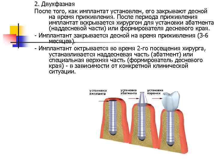 2. Двухфазная После того, как имплантат установлен, его закрывают десной на время приживления. После