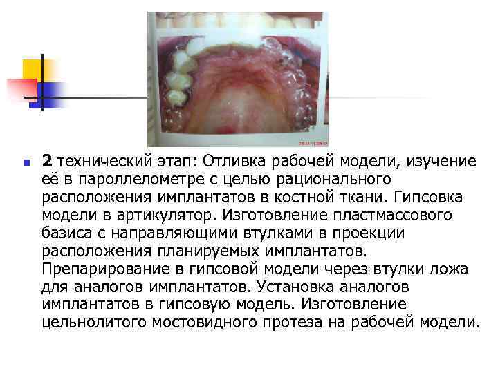 n 2 технический этап: Отливка рабочей модели, изучение её в пароллелометре с целью рационального