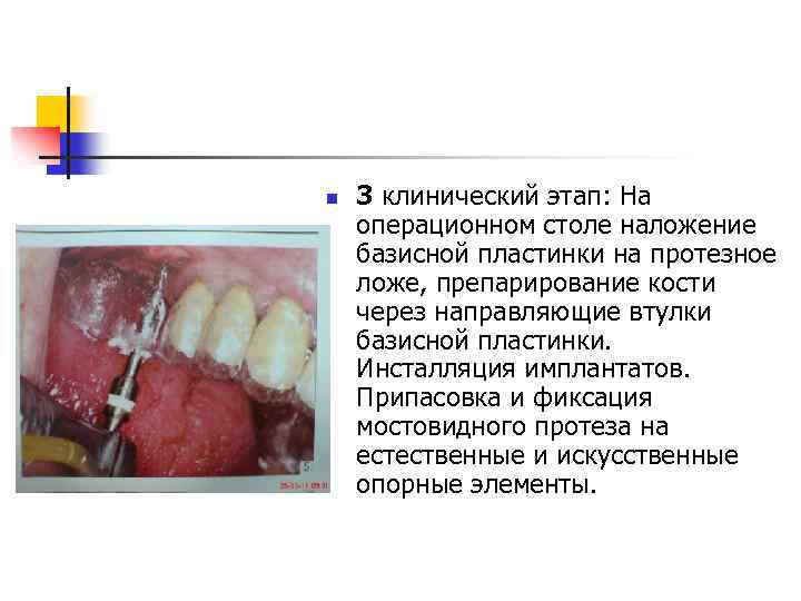 n 3 клинический этап: На операционном столе наложение базисной пластинки на протезное ложе, препарирование
