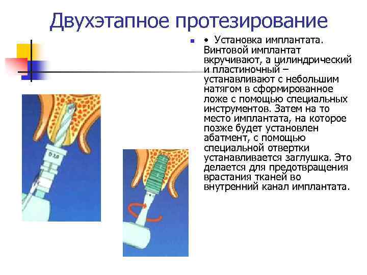 Двухэтапное протезирование n • Установка имплантата. Винтовой имплантат вкручивают, а цилиндрический и пластиночный –