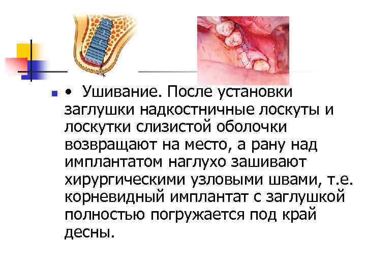 n • Ушивание. После установки заглушки надкостничные лоскуты и лоскутки слизистой оболочки возвращают на