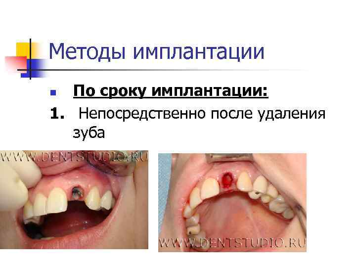 Методы имплантации По сроку имплантации: 1. Непосредственно после удаления зуба n 
