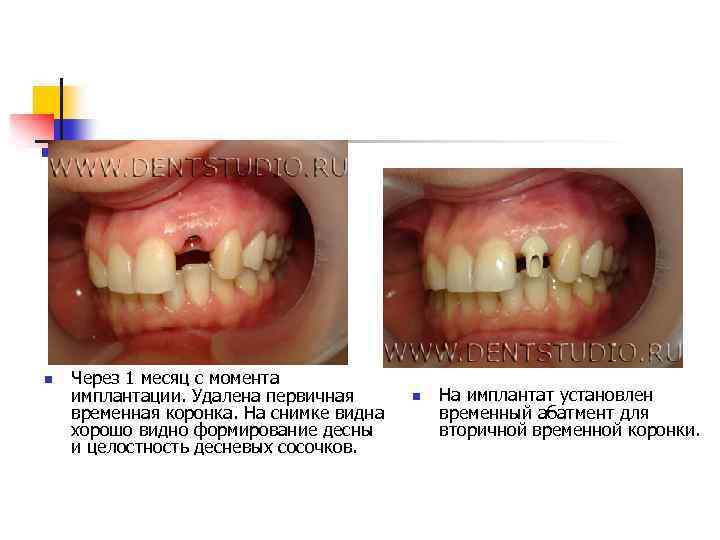 n Через 1 месяц с момента имплантации. Удалена первичная временная коронка. На снимке видна