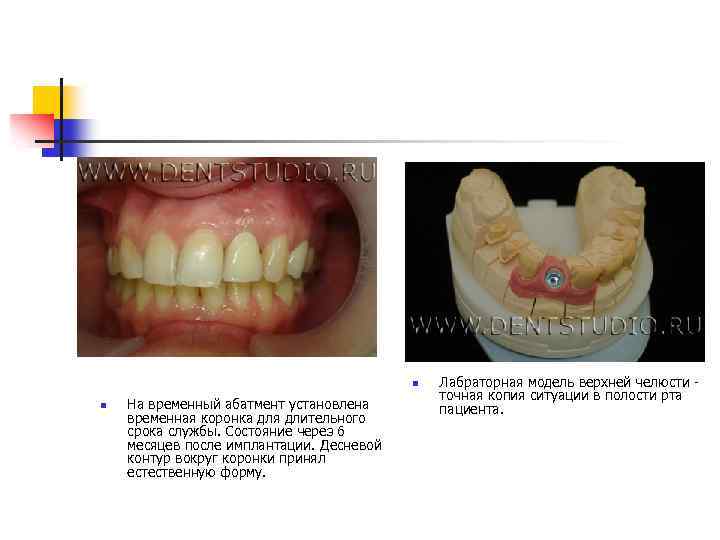 n n На временный абатмент установлена временная коронка для длительного срока службы. Состояние через