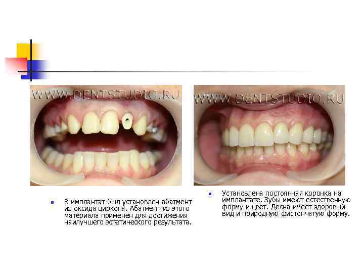 n n В имплантат был установлен абатмент из оксида циркона. Абатмент из этого материала