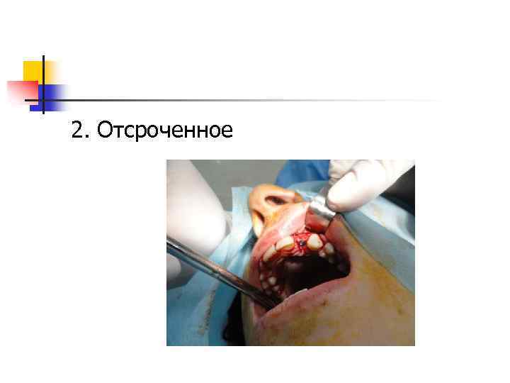 2. Отсроченное 