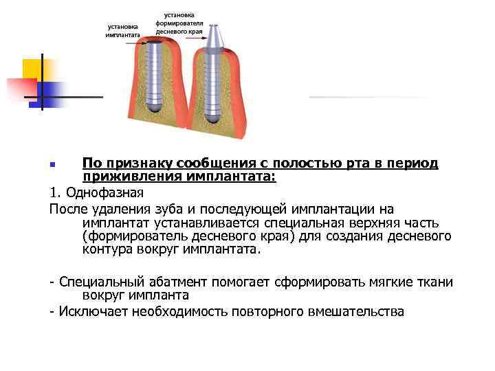 По признаку сообщения с полостью рта в период приживления имплантата: 1. Однофазная После удаления