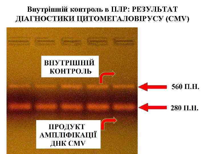 Внутрішній контроль в ПЛР: РЕЗУЛЬТАТ ДІАГНОСТИКИ ЦИТОМЕГАЛОВІРУСУ (CMV) 