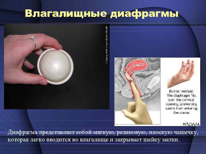 Влагалищные диафрагмы Диафрагма представляет собой мягкую, резиновую, плоскую чашечку, которая легко вводится во влагалище