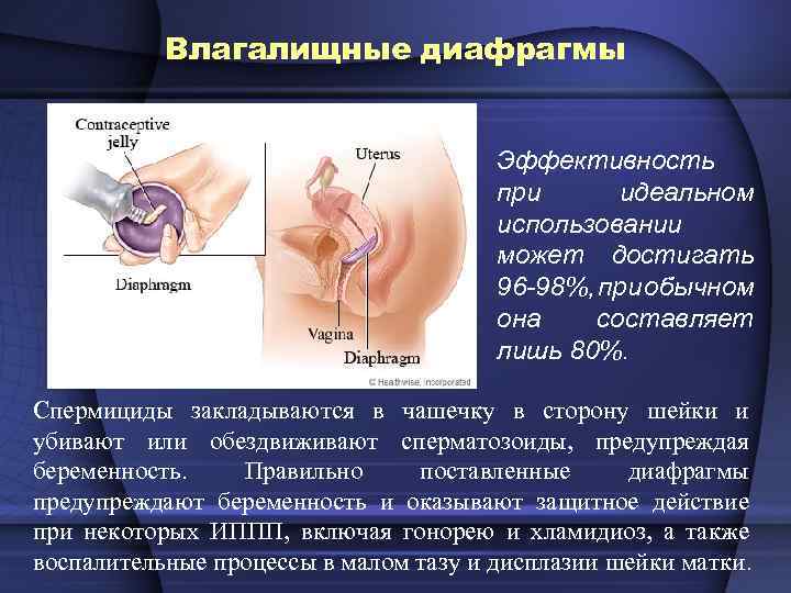 Влагалищные диафрагмы Эффективность при идеальном использовании может достигать 96 -98%, при обычном она составляет