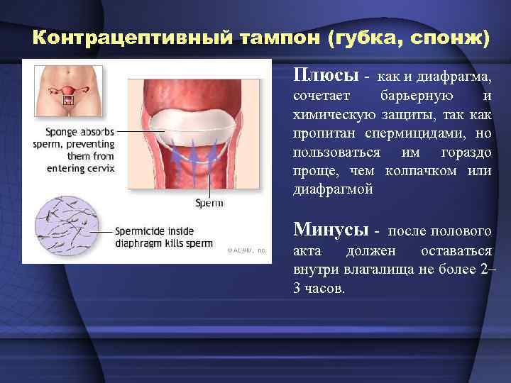 Контрацептивный тампон (губка, спонж) Плюсы - как и диафрагма, сочетает барьерную и химическую защиты,