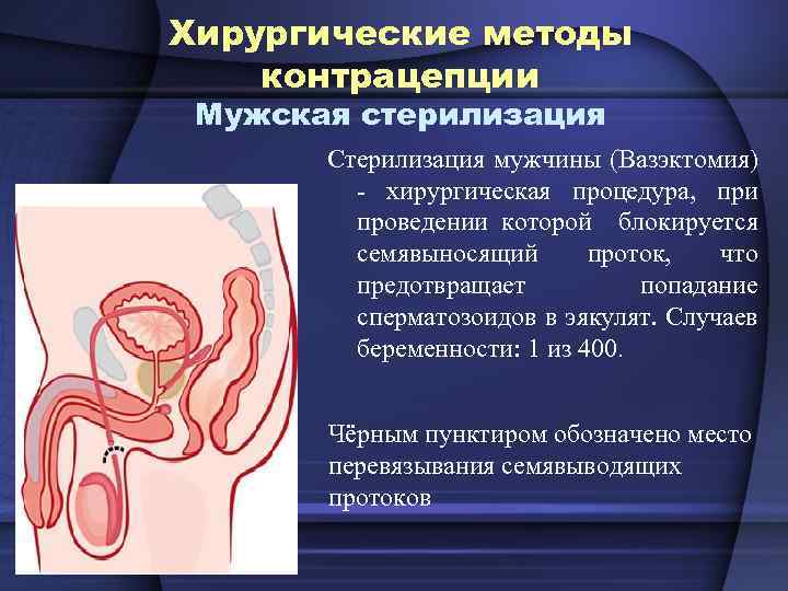 Хирургические методы контрацепции Мужская стерилизация Стерилизация мужчины (Вазэктомия) - хирургическая процедура, при проведении которой