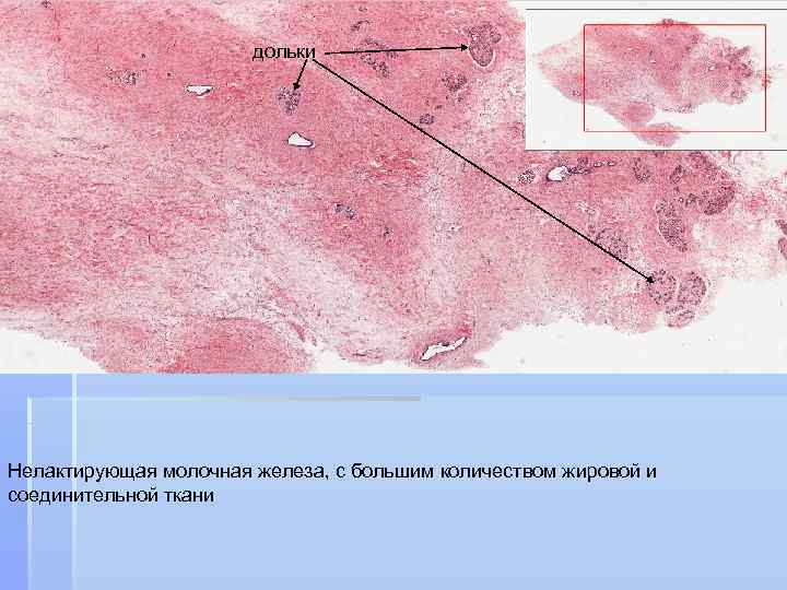 дольки 1 Нелактирующая молочная железа, с большим количеством жировой и соединительной ткани 