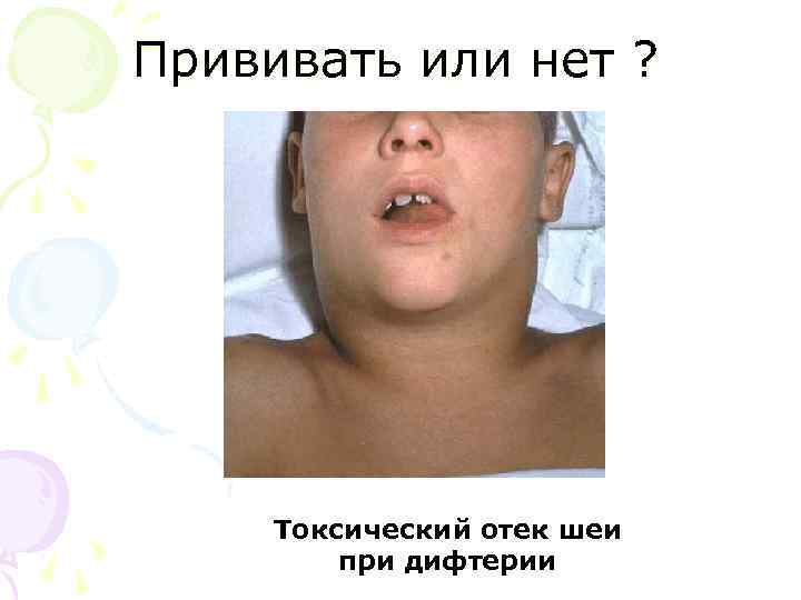 Прививать или нет ? Токсический отек шеи при дифтерии 