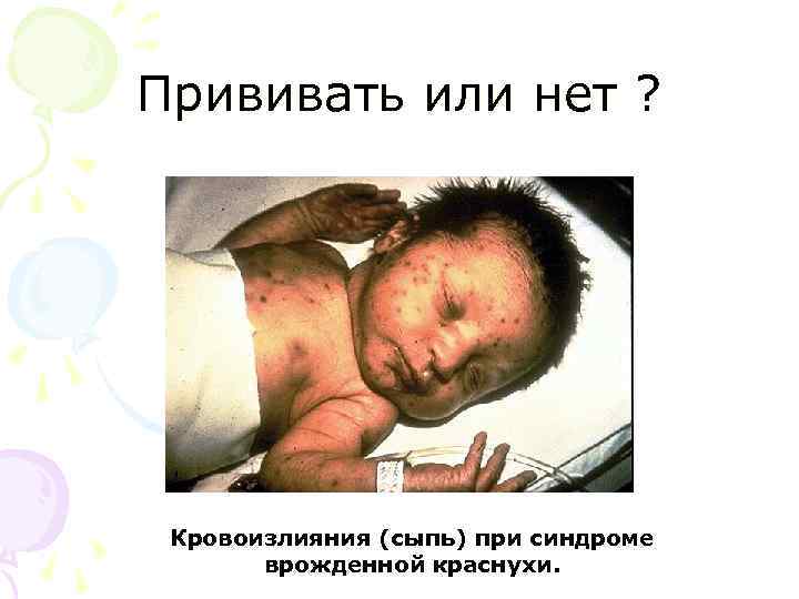 Прививать или нет ? Кровоизлияния (сыпь) при синдроме врожденной краснухи. 