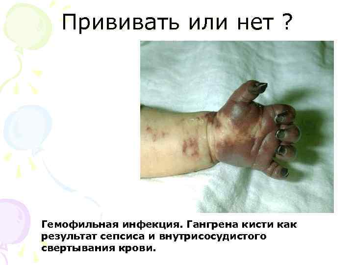 Прививать или нет ? Гемофильная инфекция. Гангрена кисти как результат сепсиса и внутрисосудистого свертывания