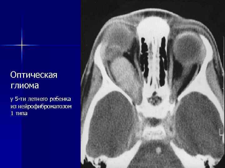  Оптическая глиома у 5 -ти летнего ребенка из нейрофиброматозом 1 типа 