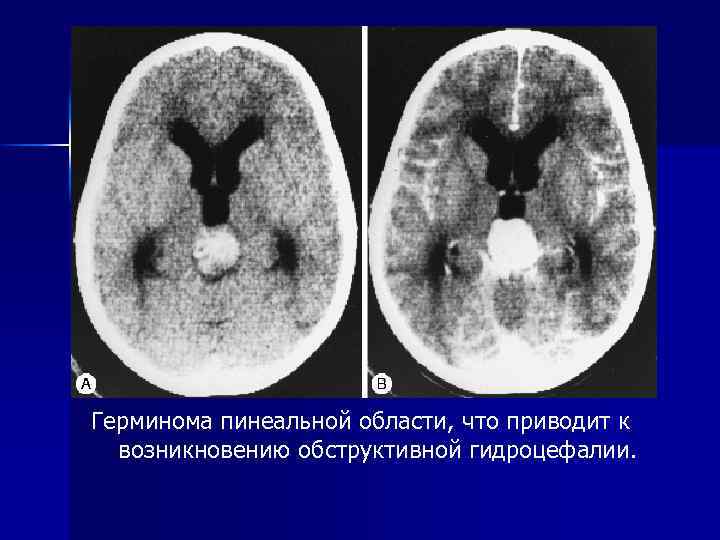 Герминома пинеальной области, что приводит к возникновению обструктивной гидроцефалии. 