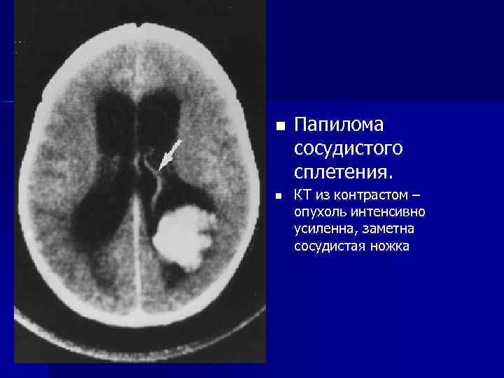 n n Папилома сосудистого сплетения. КТ из контрастом – опухоль интенсивно усиленна, заметна сосудистая