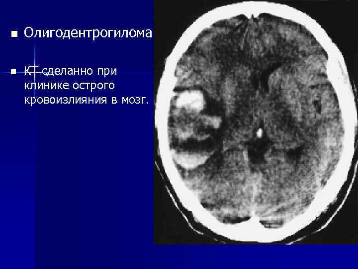 n n Олигодентрогилома КТ сделанно при клинике острого кровоизлияния в мозг. 