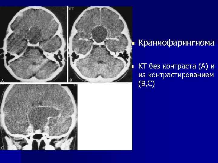 n n Краниофарингиома КТ без контраста (А) и из контрастированием (В, С) 