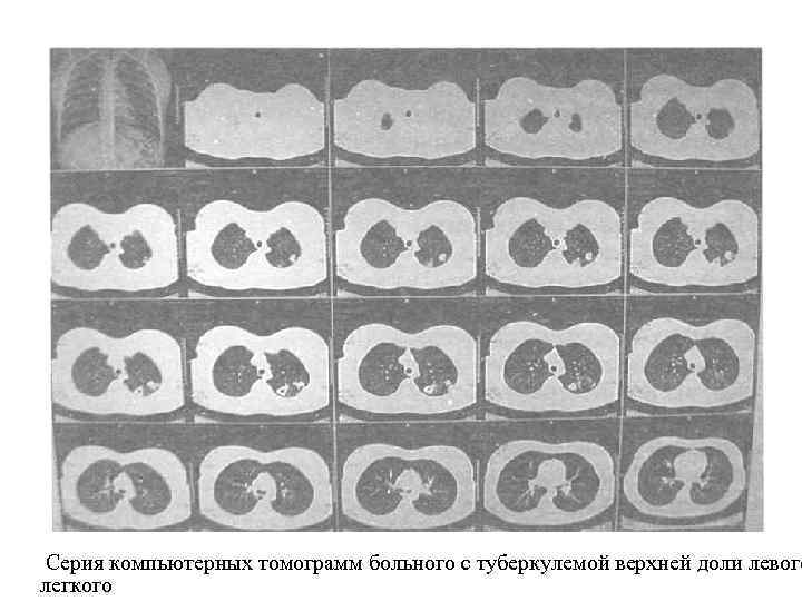 Серия компьютерных томограмм больного с туберкулемой верхней доли левого легкого 