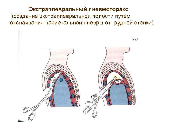 Экстраплевральный пневмоторакс (создание экстраплевральной полости путем отслаивания париетальной плевры от грудной стенки) 
