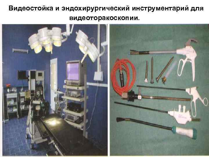  Видеостойка и эндохирургический инструментарий для видеоторакоскопии. 