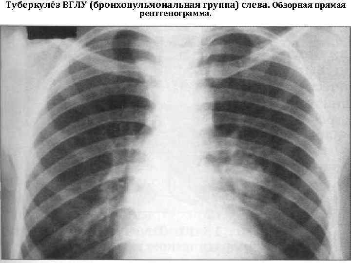 Туберкулёз ВГЛУ (бронхопульмональная группа) слева. Обзорная прямая рентгенограмма. 