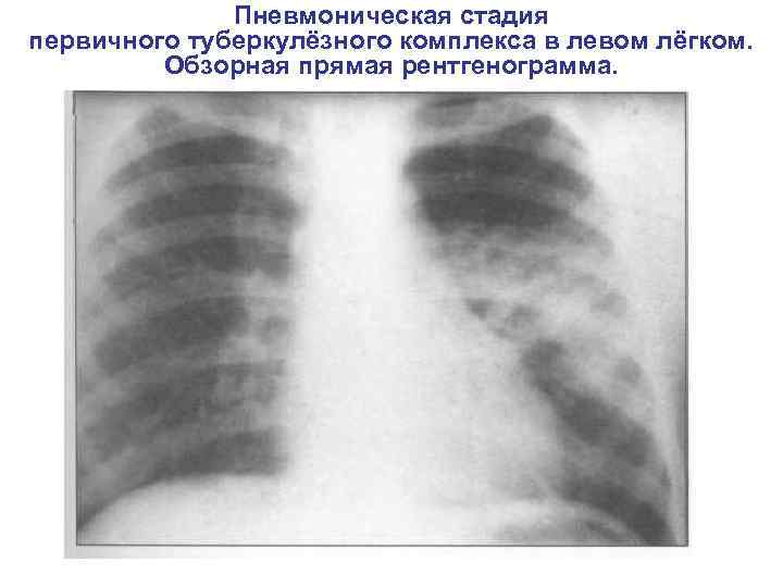Пневмоническая стадия первичного туберкулёзного комплекса в левом лёгком. Обзорная прямая рентгенограмма. 