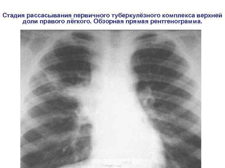 Стадия рассасывания первичного туберкулёзного комплекса верхней доли правого лёгкого. Обзорная прямая рентгенограмма. 