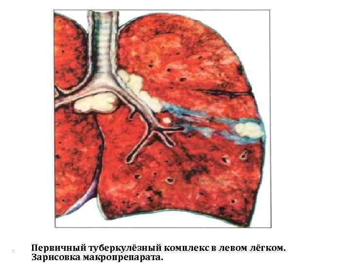 . Первичный туберкулёзный комплекс в левом лёгком. Зарисовка макропрепарата. 