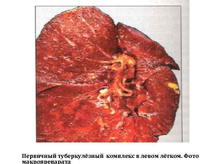 Первичный туберкулёзный комплекс в левом лёгком. Фото макропрепарата. 