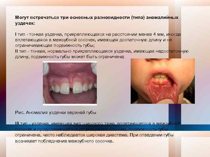 Могут встречаться три основных разновидности (типа) аномалийных уздечек: I тип тонкая уздечка, прикрепляющаяся на