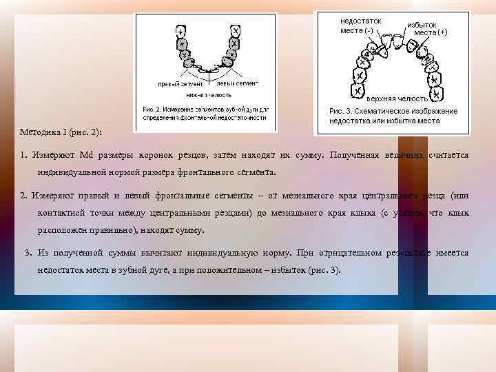 Методика I (рис. 2): 1. Измеряют Мd размеры коронок резцов, затем находят их сумму.