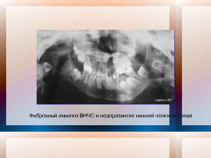 Фиброзный анкилоз ВНЧС и недоразвитие нижней челюсти слева 